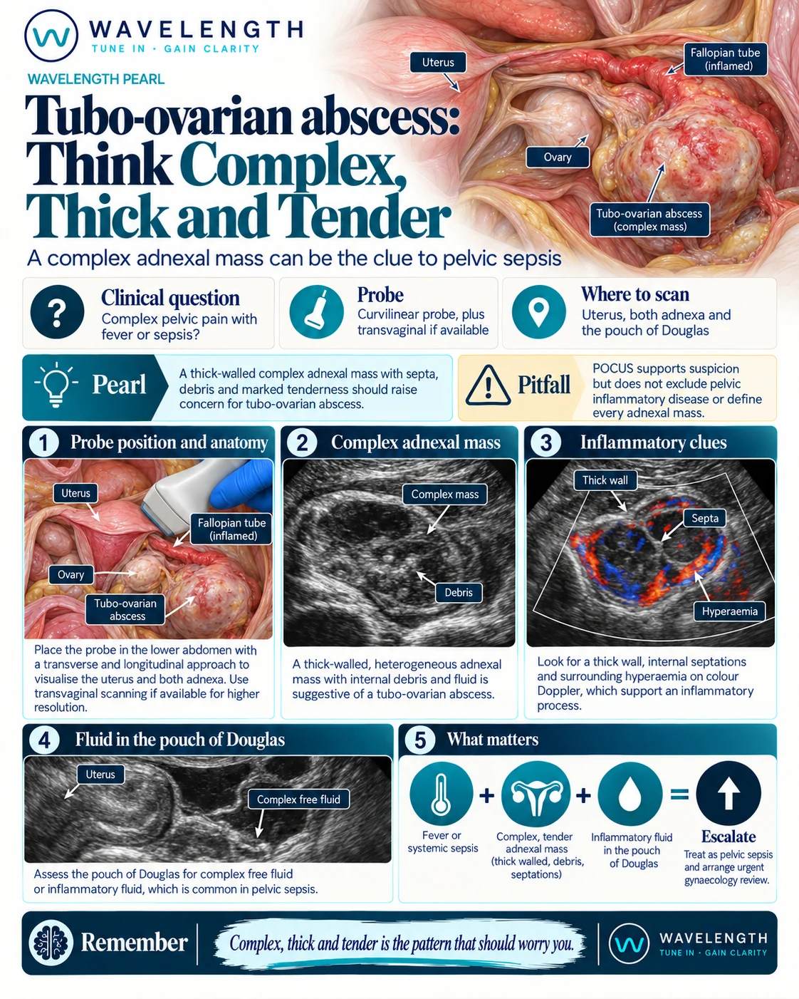 Wavelength Pearl: tubo-ovarian abscess. A thick-walled complex adnexal mass with septa, debris, hyperaemia and tenderness.