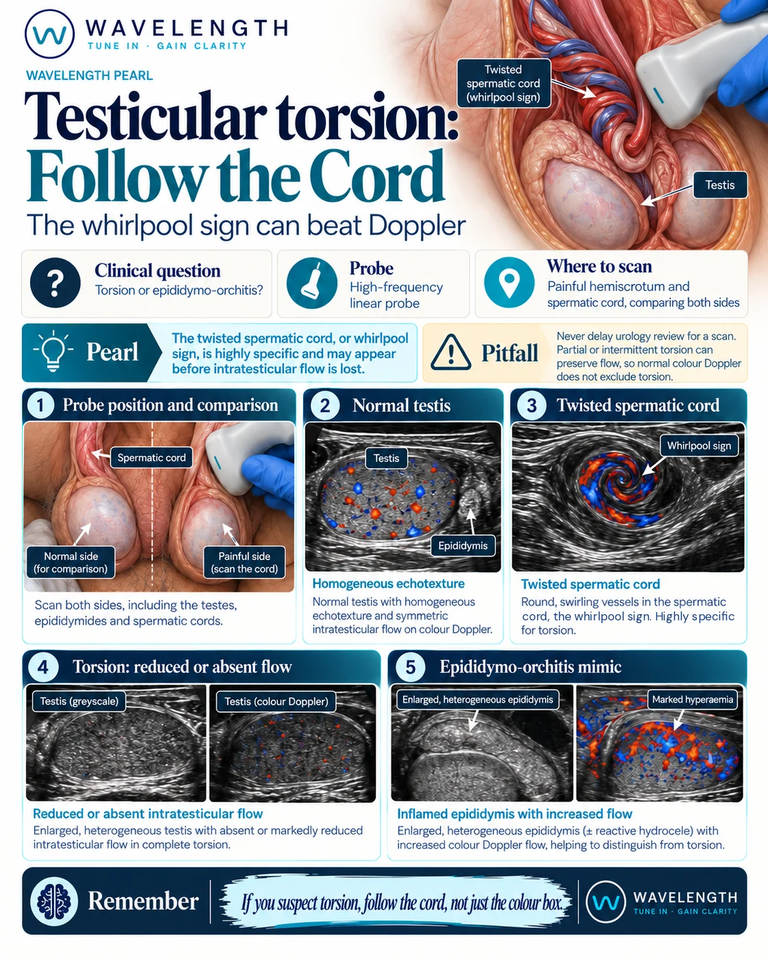 Wavelength Pearl: testicular torsion. Follow the cord. The twisted spermatic cord, the whirlpool sign, is highly specific for torsion.