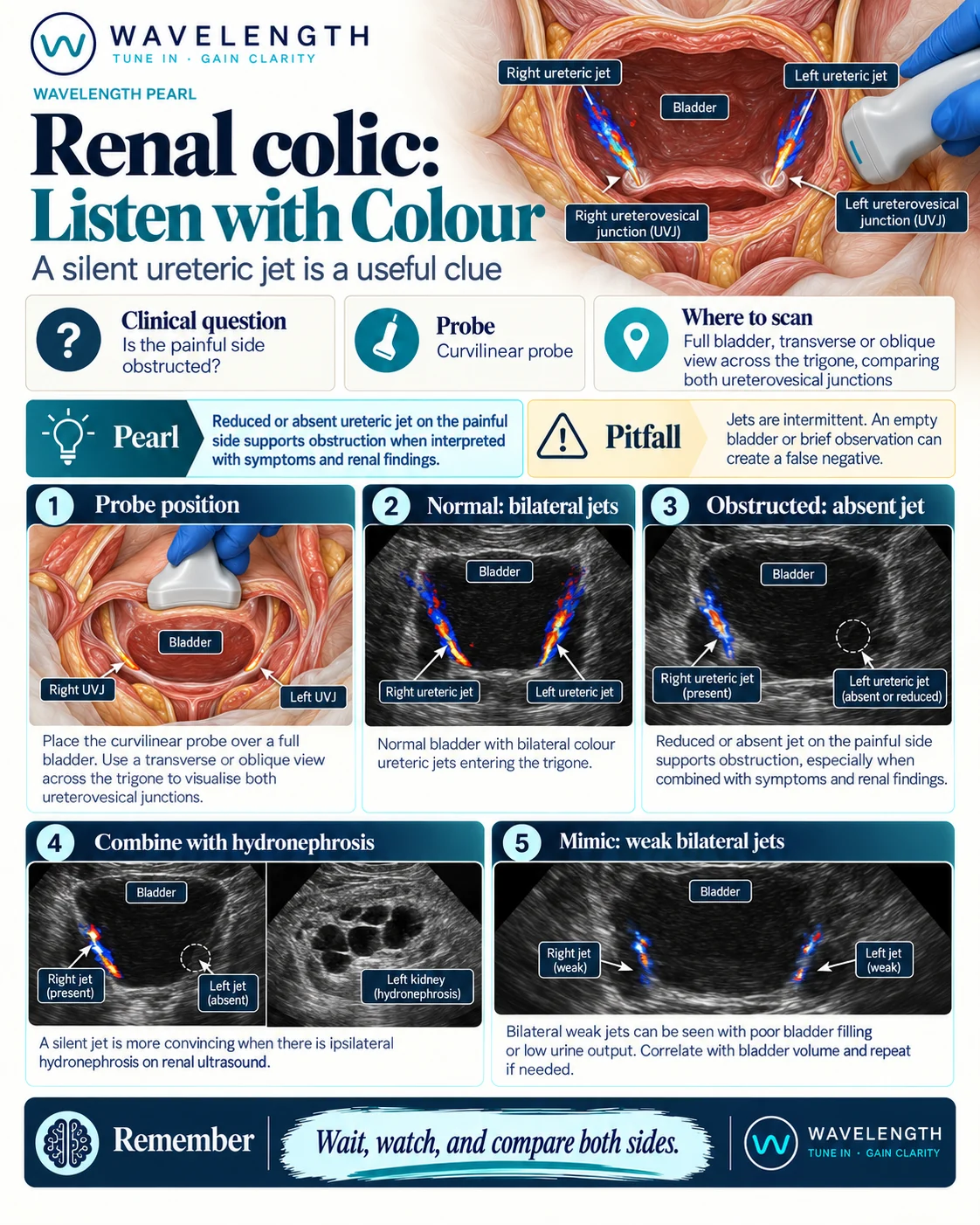 Wavelength Pearl: renal colic. Colour Doppler over a full bladder shows ureteric jets. A silent jet on the painful side supports obstruction.
