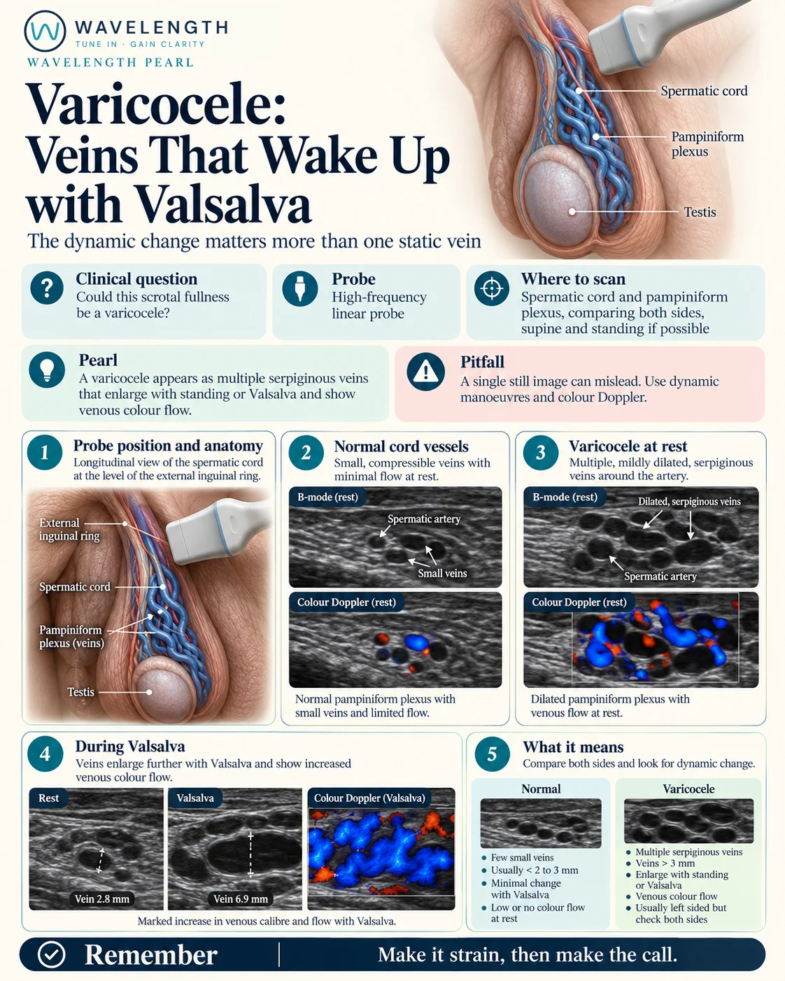 Wavelength Pearl: varicocele. Small cord veins at rest, dilated serpiginous veins, and veins enlarging with flow during Valsalva.